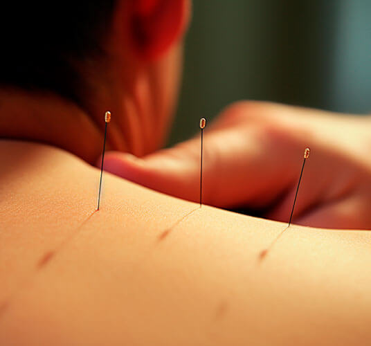 Physiotherapist performing acupuncture treatment on a patient