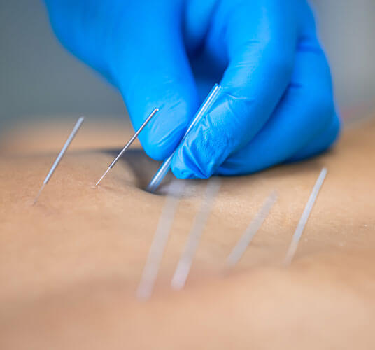 Physiotherapist performing IMS dry needling therapy