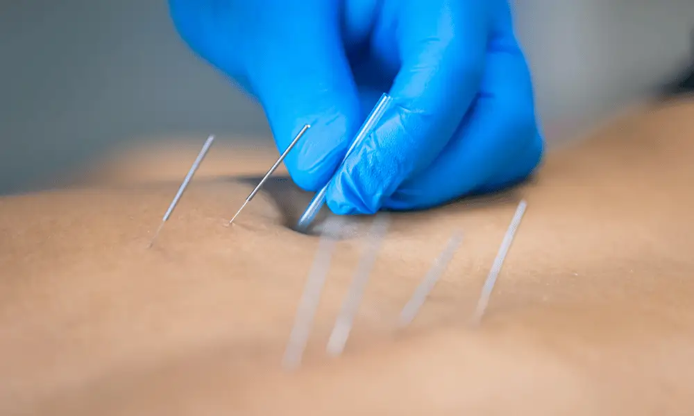 dry needling